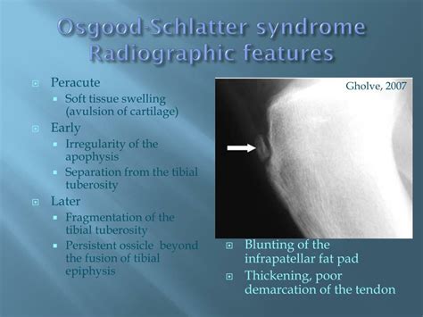 Ppt Osgood Schlatter Syndrome Powerpoint Presentation Free Download