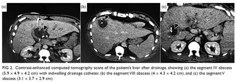 Amoebic Liver Abscesses With An Unusual Source A Case Report Hkmj