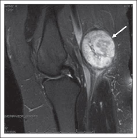 Figure 4 From Schwannoma Of The Tibial Nerve Semantic Scholar