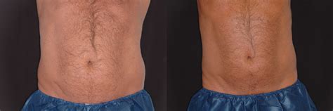 Love Handles Before And After Coolsculpting Wien