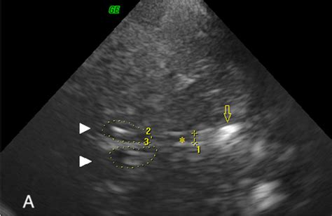 Ultrasound Measurements Of The Third Ventricle A And Of The B