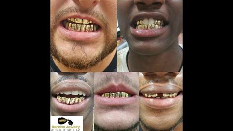 You are usually required to purchase a molding kit to mold your teeth and send it back to get them made. Permanent Gold Teeth In Jacksonville Florida - TeethWalls