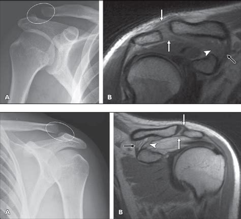 Figure 5 From Mri Versus Radiography Of Acromioclavicular Joint