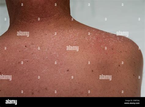 Dermatitis Solaris Hi Res Stock Photography And Images Alamy