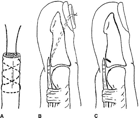 A Bunnell Technique Of Suture Insertion Into The Tendon B Pullout