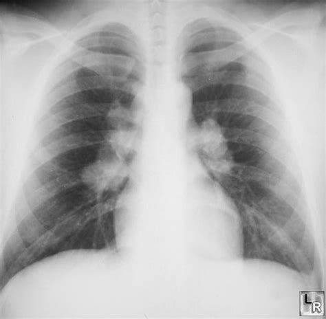 Sarcoidosis Frontal View Of The Chest Shows Bilateral Hilar Adenopathy