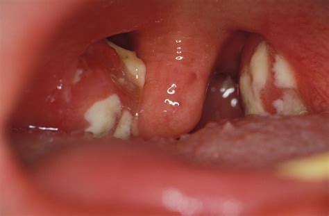 Tonsils In Glandular Fever Photograph By Dr Ma Ansaryscience Photo