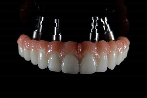 Hybrid Overdentures Titanium Bars Prototypes Digital Dental Lab