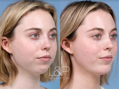 Buccal Fat Removal Before And After Photo Gallery Palo Alto And San Jose California Landp
