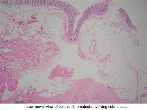 Pathology Outlines Fibromatosis
