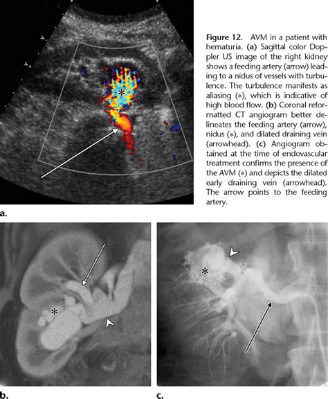 Figure 1 From Radiologic Assessment Of Native Renal Vasculature A