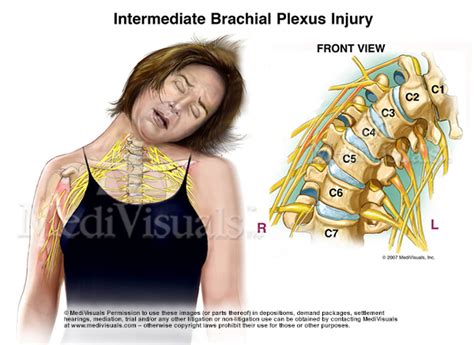 Brachial Plexus Injury Symptoms