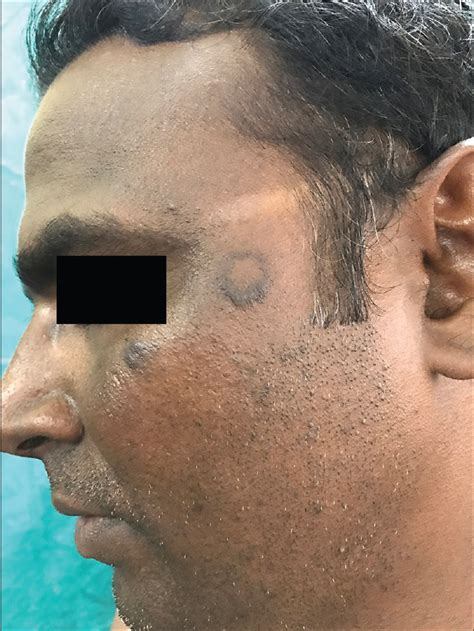 Histoid Leprosy Presenting With Figurate Lesions A Unique And Rare