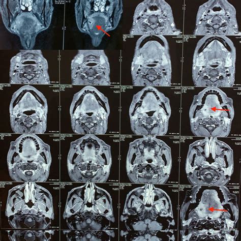 Contrast Enhanced Magnetic Resonance Imaging Scan Axial Sections