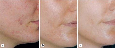 Pdf Azelaic Acid In The Treatment Of Acne In Adult Females Case