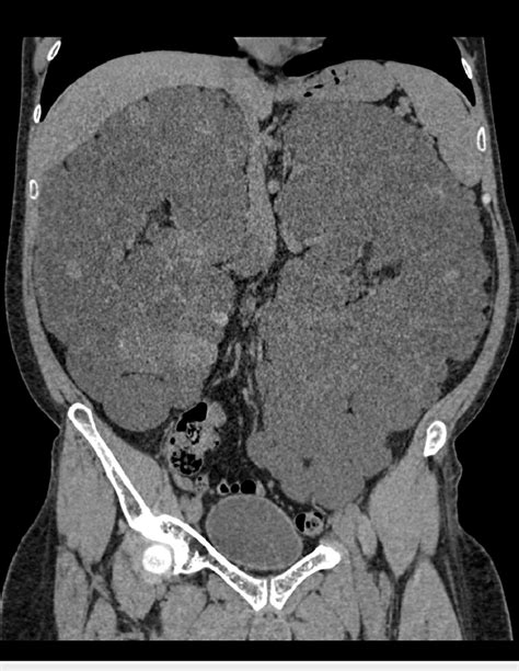 Abdominal Ct Scan Showing Markedly Enlarged Kidneys Bilaterally