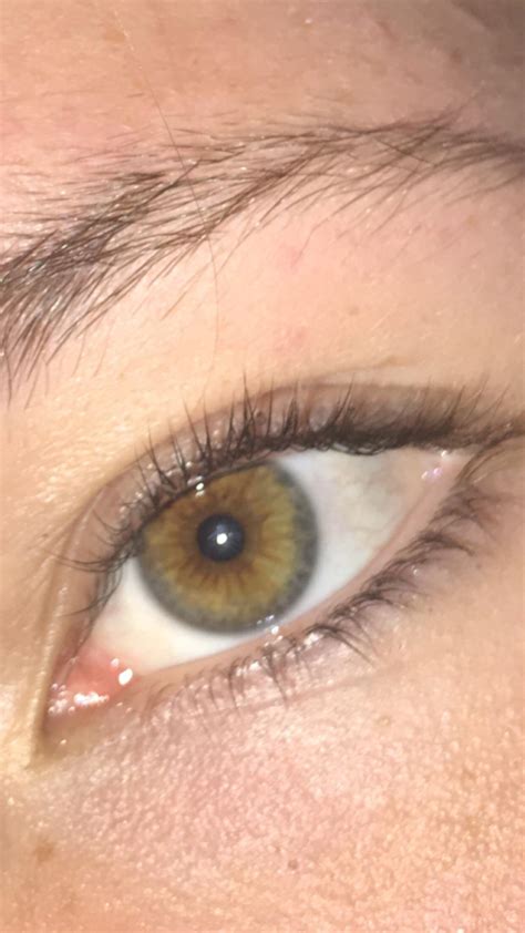 Central Heterochromia Hazel