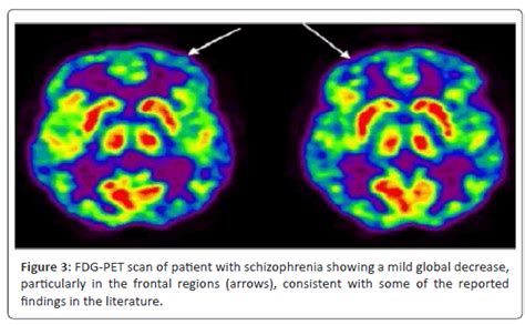 Schizophrenia Brain Scan
