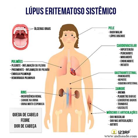 Lúpus Eritematoso Sistêmico Sintomas E Tratamento Mdsaúde