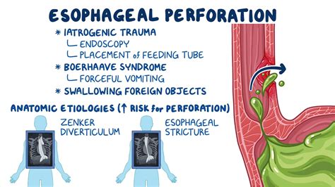 Esophageal Perforation Clinical Sciences Osmosis Video Library