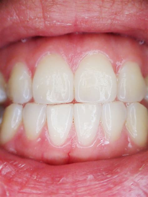 What Do Having White Gums Mean Sage Dental