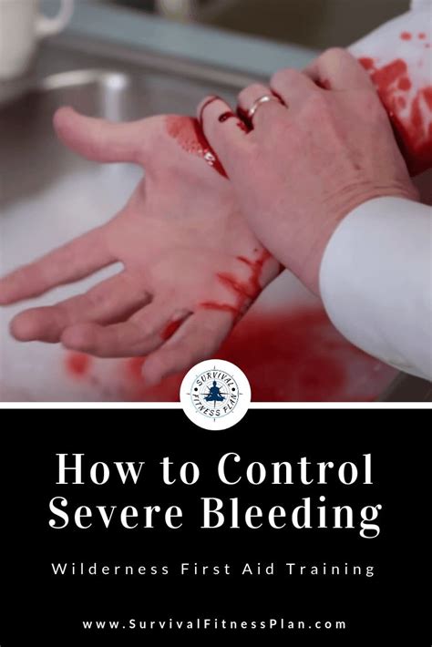 First Aid For Severe Bleeding Wilderness First Aid In 2020