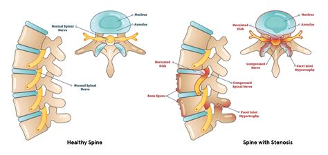 Spinal Stenosis Definition Causes Symptoms Diagnosis And Treatment Spine Info