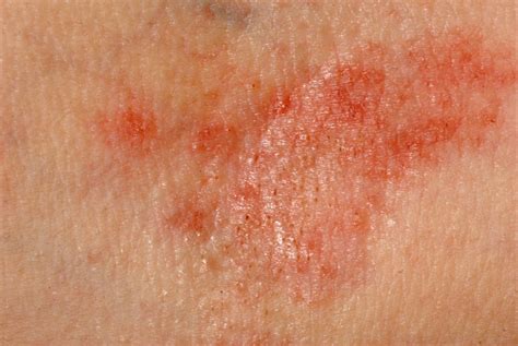 Allergic Rash Dermatitis Skin Attachment Urgent London Doctors