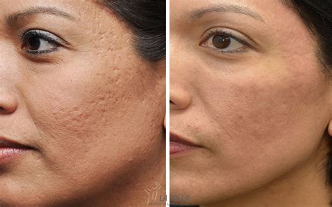 Scars And How To Minimize Them Comprehensive Dermatology Center Of