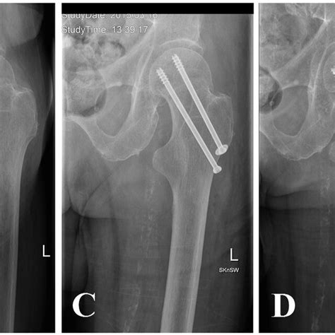 Radiographic Evaluation Of A Patient With Garden I Femoral Neck