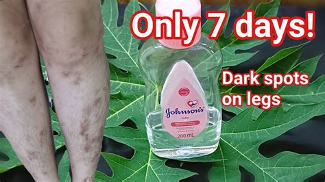 Only 7 Days How To Remove Dark Spots On Legsscar Mosquito Bites