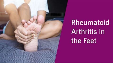 Rheumatoid Arthritis In The Feet What To Know