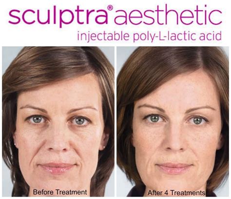 Sculptra® Aesthetic Is Intended For Use In People With Healthy Immune