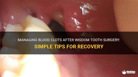 Managing Blood Clots After Wisdom Tooth Surgery Simple Tips For