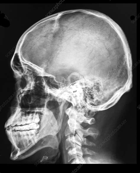 Lateral X Ray Of Skull Stock Image C0430235 Science Photo Library