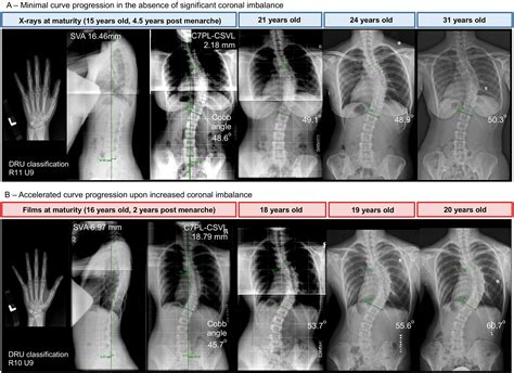 Scoliosis Progression After Skeletal Maturity Whats Likely For Curves