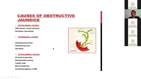 Obstructive Jaundice Causes Symptoms And Treatment Surgery Lecture