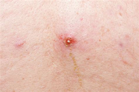 Infected Sebaceous Cyst Photograph By Dr P Marazziscience Photo Library