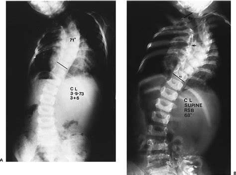 The Different Types Of Scoliosis And Kyphosis Brandon Orthopedics