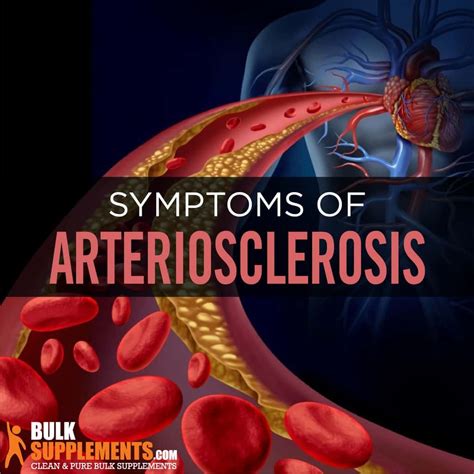 What Is Arteriosclerosis Symptoms Causes And Treatment