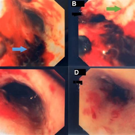 Upper Endoscopy Pictures Showing A And B Cervical Hemorrhagic