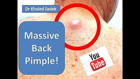 Large Sebaceous Cyst Removal Dr Khaled Sadek Dr