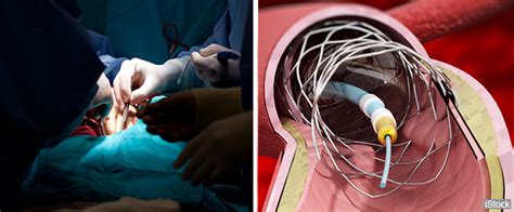 Bypass Surgery Vs Stents Which Is Better For Quality Of
