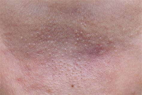 Heat Bumps On Black Skin