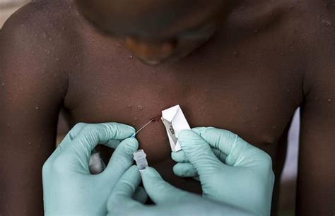 The virus can enter the body through broken skin, the respiratory tract or through the eyes, nose or mouth. Monkeypox : Human Monkeypox An Emerging Zoonosis The ...