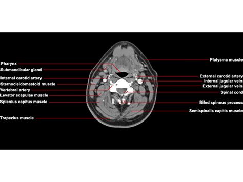 Ct Neck Axial Anatomy Radiologypicscom