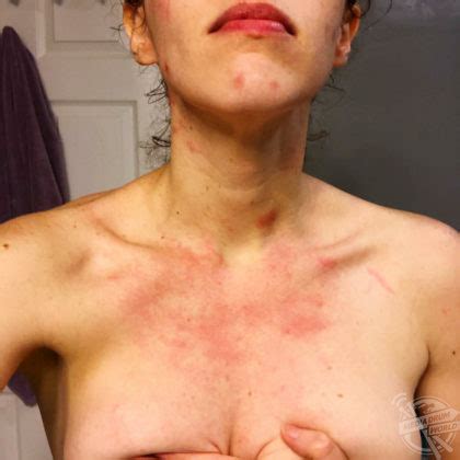 This Woman Feared She Had Leprosy After Suffering From Sores That