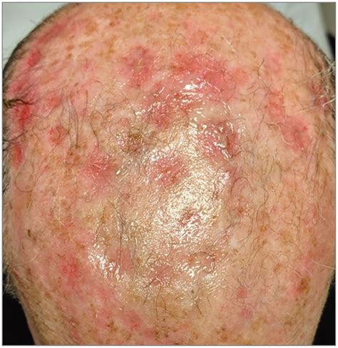 Scalp Eruption In A Patient With Metastatic Colon Cancer Colorectal
