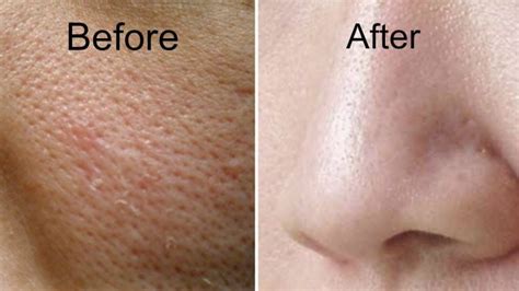 Large Pores Treatment In Dubai Laser Skin Care Clinic Dubai