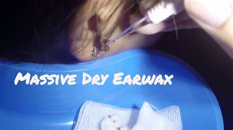 Massive Dry Close Up Earwax Removal Youtube